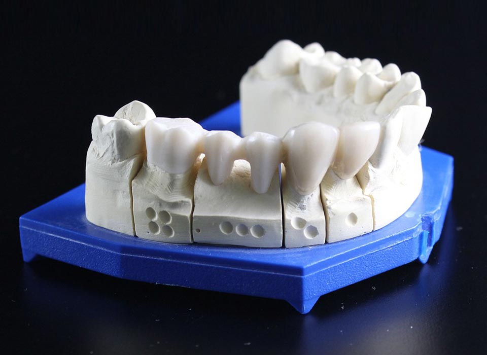 Dental Crown and Bridges