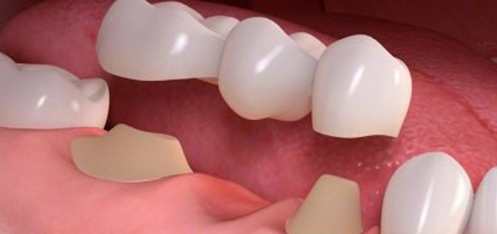 Dental Bridge Cost In Mississauga - Bristol Dental Care