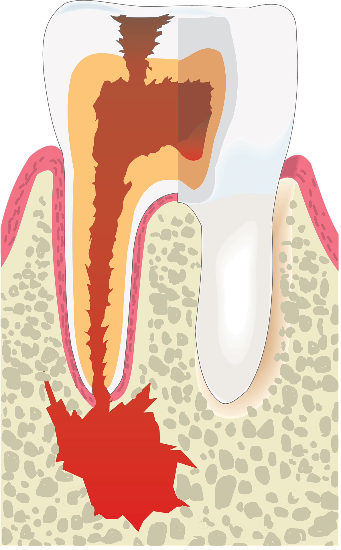 Root canal illustration - Mississauga Dentist - Bristol Dental