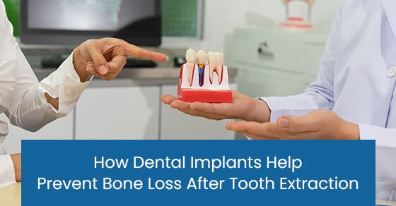 How dental implants help prevent bone loss after tooth extraction